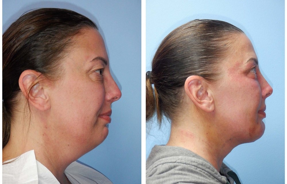 NeckTite™ in Bloomfield Hills, MI