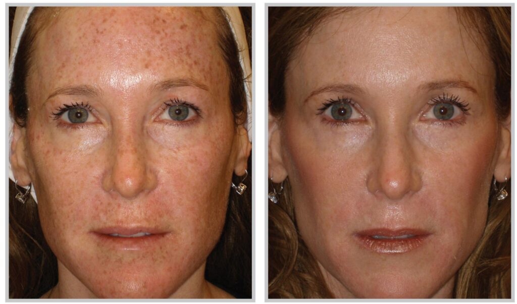 Before and After Image: BBL - front