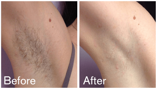 Before and After Image: Hair Removal - front