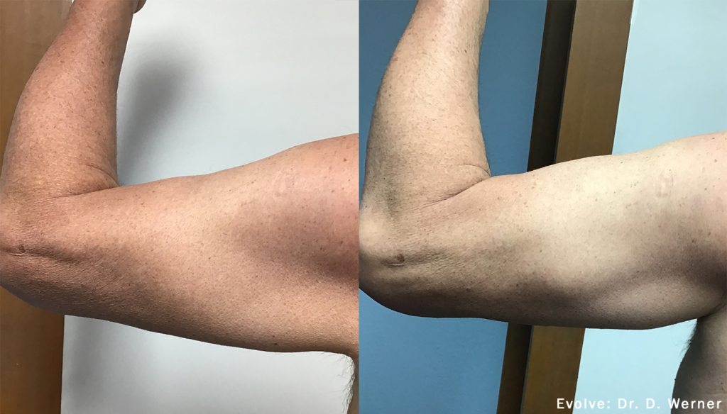 Before and After Image: Evolve Tite - other
