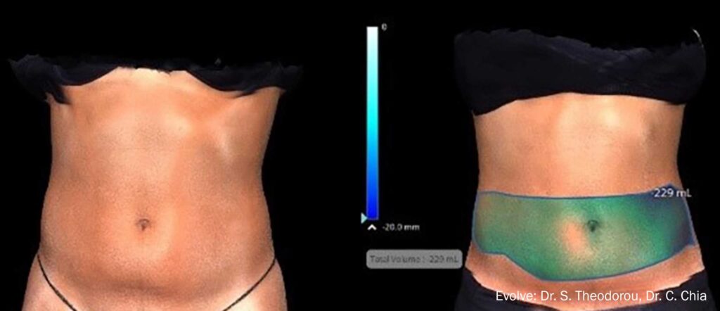 Before and After Image: Evolve Tone - front