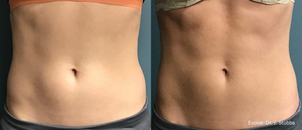 Before and After Image: Evolve Transform - front