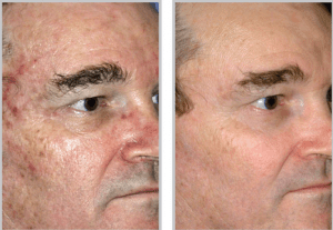 Before and After Image: Sciton - right-side