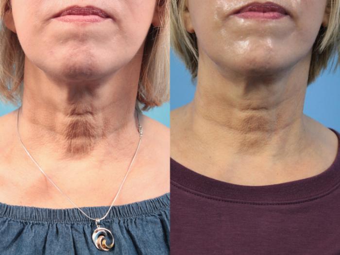 Before and After Image: SkinTyte - front